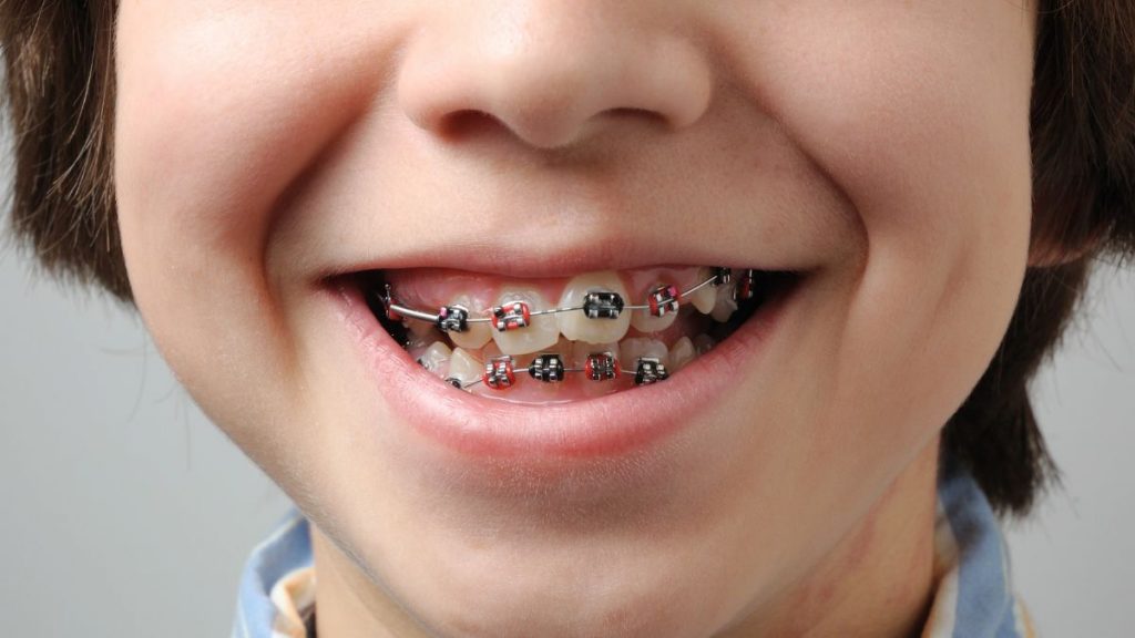 Информацию о бесплатных брекетах детям в Казахстане опровергли в ФСМС брекеты