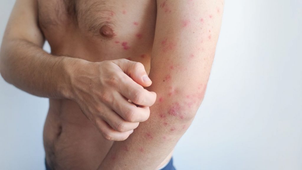 Карантин ввели в военном колледже в Щучинске корь