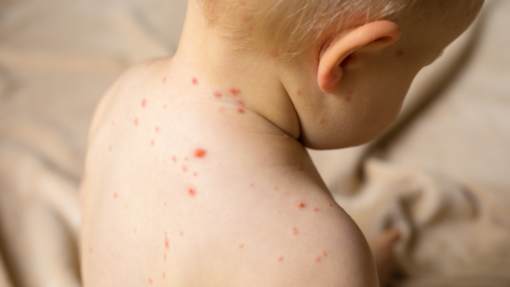 Почти 500 детей в Астане заболели корью с начала года