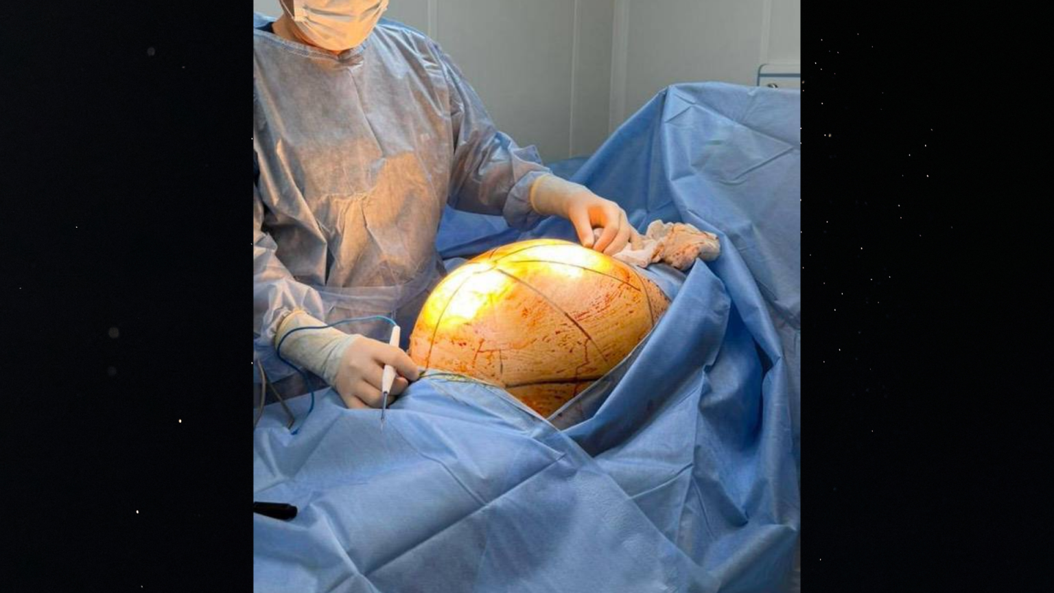 В Алматы пациентке удалили 25 килограммовую опухоль