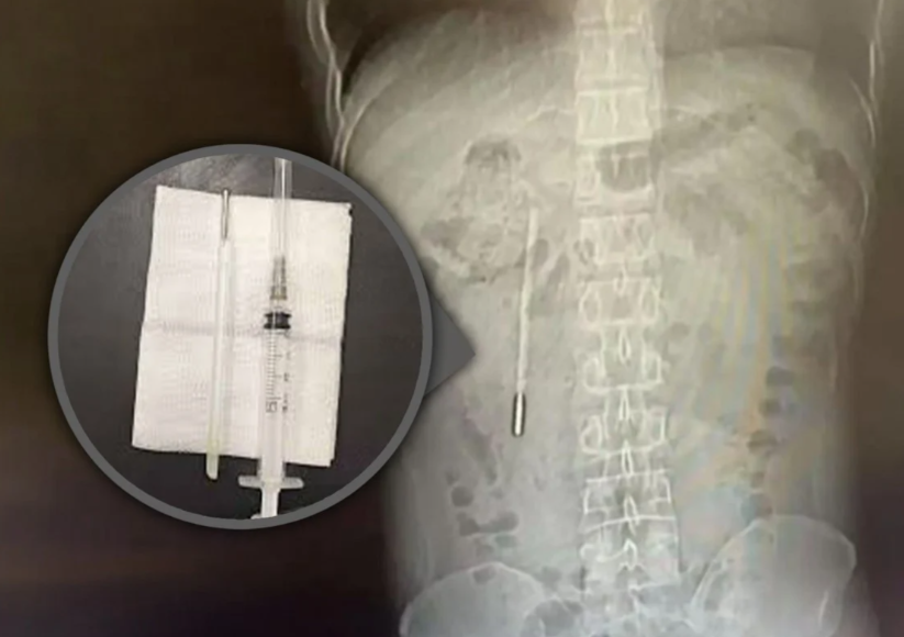 Житель Китая 20 лет прожил с градусником в животе