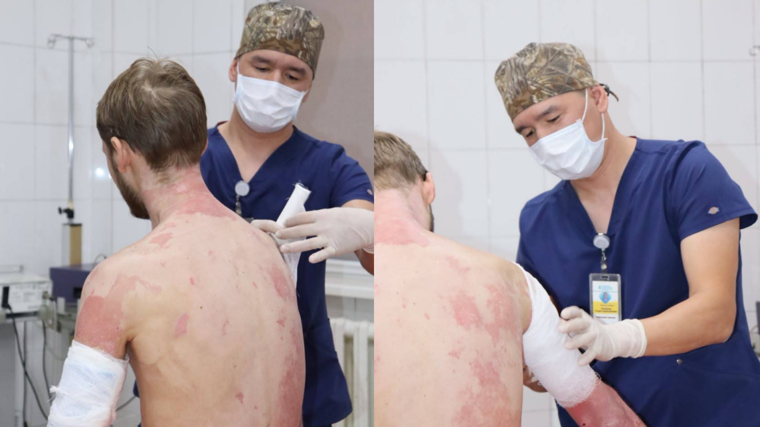 Алматинские врачи спасли мужчину с ожогами почти 90% тела